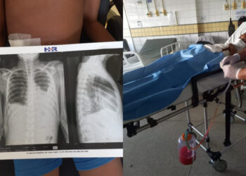 O adolescente teve o apêndice retirado, além de múltiplas lesões e está tratando água nos pulmões