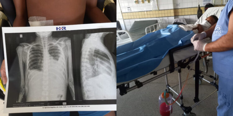 O adolescente teve o apêndice retirado, além de múltiplas lesões e está tratando água nos pulmões