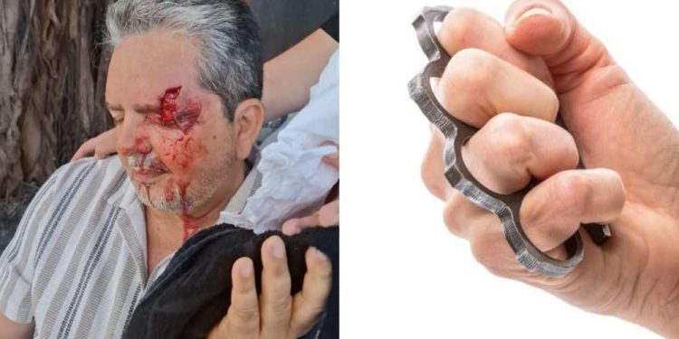 Ataque com soco-inglês deixa jornalista Ricardo Antunes ferido em Boa Viagem