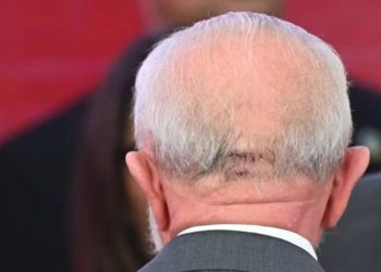 "Lula passa por cirurgia para drenagem de hemorragia intracraniana e está consciente