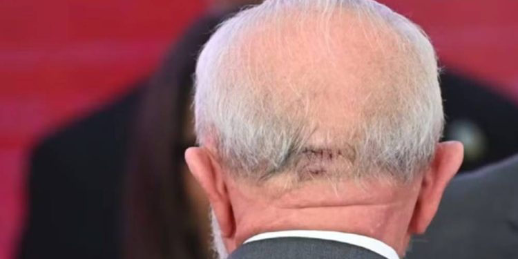 "Lula passa por cirurgia para drenagem de hemorragia intracraniana e está consciente