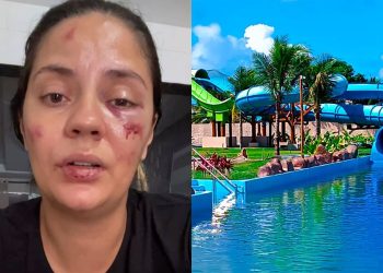 Jaqueline Nascimento sofreu ferimentos no rosto e na boca após acidente em montanha russa.