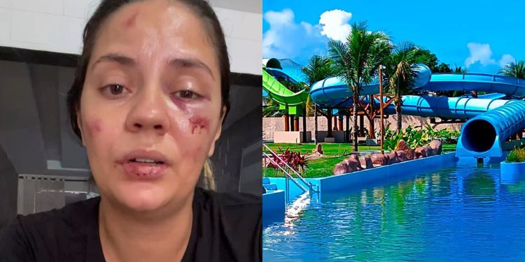 Jaqueline Nascimento sofreu ferimentos no rosto e na boca após acidente em montanha russa.