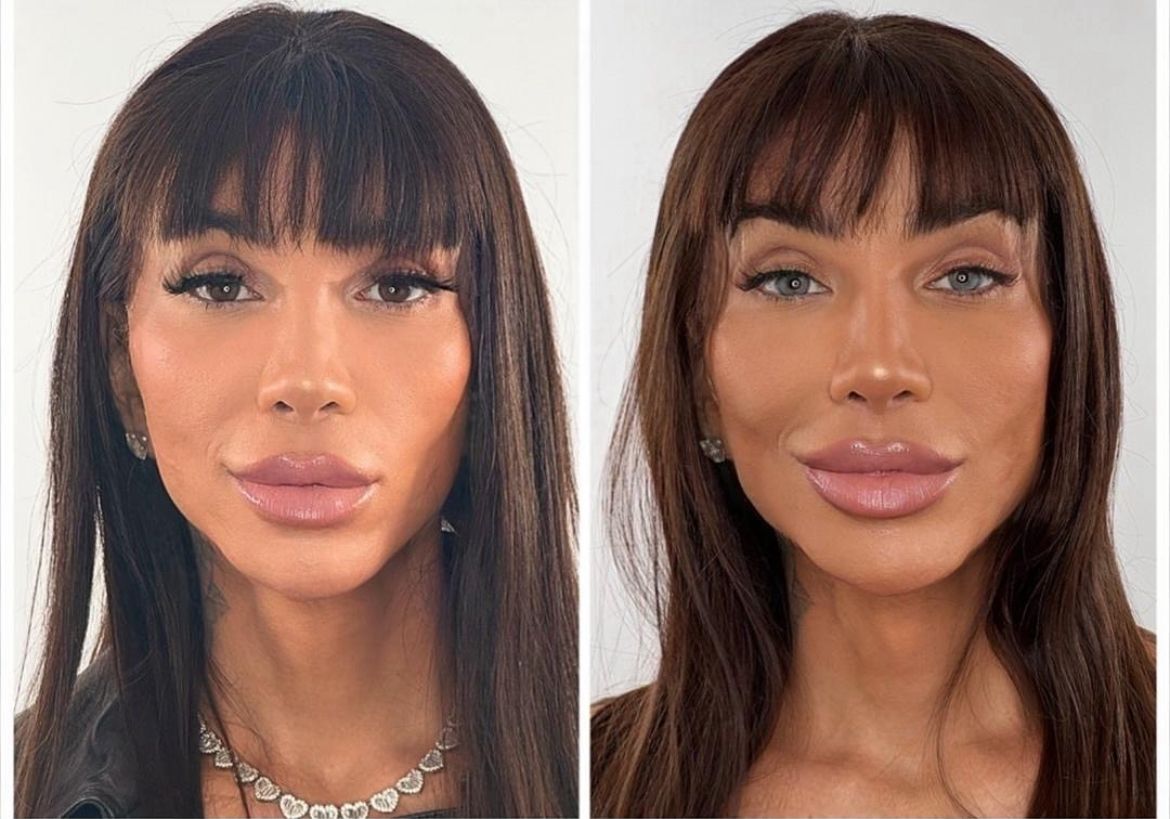 Procedimento estético visa mudanças na cor dos olhos 