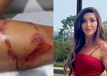 Tayane Cachoeira Dalazen turista que levou mordida de tubarão