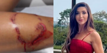 Tayane Cachoeira Dalazen turista que levou mordida de tubarão