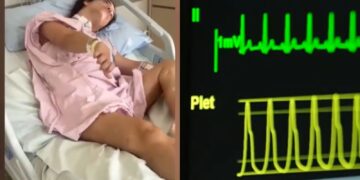 Camila passou por cirurgias para correção de hérnia e retirada da vesícula