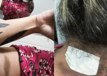 Ex-companheira do PM, Helen Kelly de Lima Pedrosa, exibe hematomas