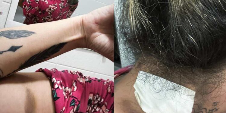 Ex-companheira do PM, Helen Kelly de Lima Pedrosa, exibe hematomas